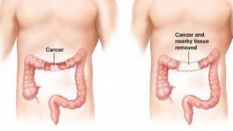 Second-look syst&eacute;matique &agrave; 1 an chez les patients &agrave; haut risque de d&eacute;velopper une carcinose p&eacute;riton&eacute;ale d&rsquo;origine colorectale