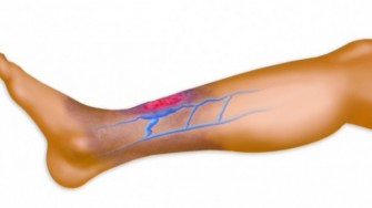 Les ulc&egrave;res digitaux de la scl&eacute;rodermie syst&eacute;mique