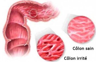 Quel r&eacute;gime &agrave; adopter pour le c&ocirc;lon irritable