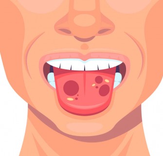 Le cancer de la langue