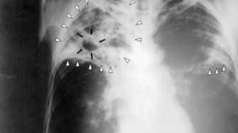 Tuberculose: nouveau test pour am&eacute;liorer le d&eacute;pistage dans les pays pauvres