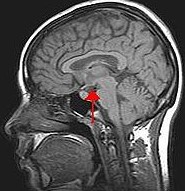 Ad&eacute;nome de lhypophyse