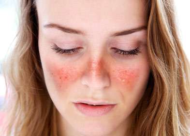 10 Mai : Journ&eacute;e mondiale du Lupus