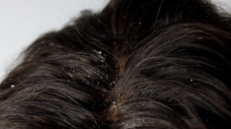 Pellicules et d&eacute;mangeaisons