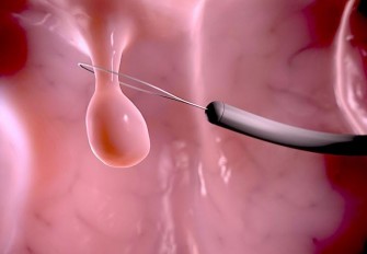 Emission Radio : polypes et cancer, d&eacute;pistage pr&eacute;coce des polypes du syst&egrave;me digestif.  