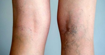 Phl&eacute;bite et embolie pulmonaire