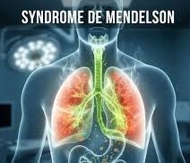Le syndrome de Mendelson