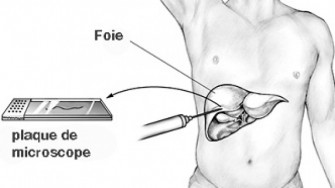 Diss&eacute;mination tumorale le long du trajet de ponction biopsie h&eacute;patique : pas si rare ?
