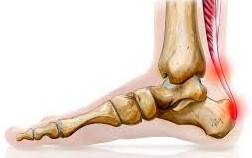 Tendinite du tendon d&rsquo;Achille