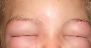 Loed&egrave;me de Quincke