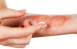 Bons r&eacute;flexes en cas de br&ucirc;lure