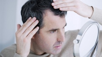 La perte des cheveux ou alop&eacute;cie