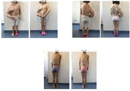 Le syndrome de Cloves