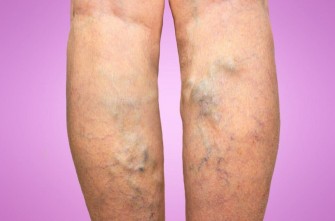 Signes avant-coureurs dune phl&eacute;bite