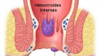 H&eacute;morro&iuml;des, maladie b&eacute;nigne mais taboue !