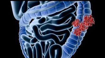 Les cancers colorectaux d&eacute;velopp&eacute;s &agrave; partir de l&eacute;sion non polypo&iuml;des seraient-ils plus fr&eacute;quents que ceux d&eacute;velopp&eacute;s &agrave; partir de polypes ad&eacute;nomateux ?