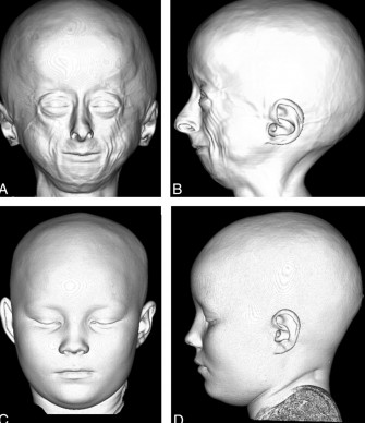 Prog&eacute;ria (syndrome de Hutchinson-Gilford)