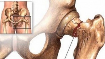  Fractures de hanche: nouvelles donn&eacute;es &eacute;pid&eacute;miologiques