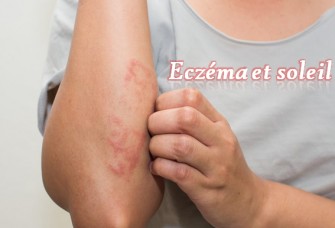 Ecz&eacute;ma et soleil