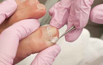 Soigner les ongles incarn&eacute;s 