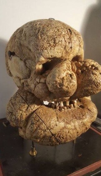 Syndrome de prot&eacute;e