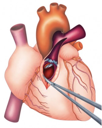 T&eacute;tralogie de Fallot