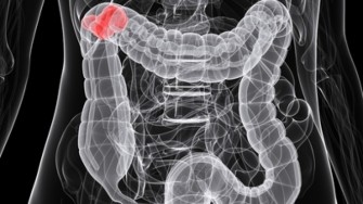 Carcinogen&egrave;se colorectale