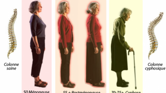Ost&eacute;oporose & risque de fractures osseuses chez le sujet &acirc;g&eacute;