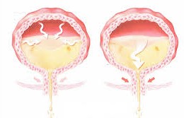 Hyperactivit&eacute; v&eacute;sicale 