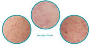 Lutter contre la k&eacute;ratose pilaire naturellement