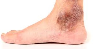  Ulc&egrave;re variqueux