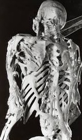 La fibrodysplasie ossifiante progressive (FOP)