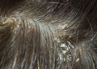 La dermatite s&eacute;borrh&eacute;ique de ladulte