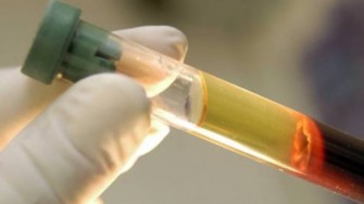 Cancer colorectal m&eacute;tastatique : les cellules tumorales circulantes sont un facteur pronostique ind&eacute;pendant.