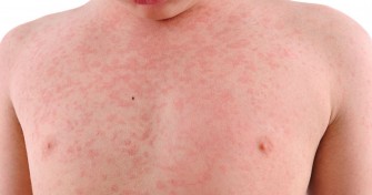 &Eacute;ryth&egrave;me infectieux (infection par le parvovirus B19)