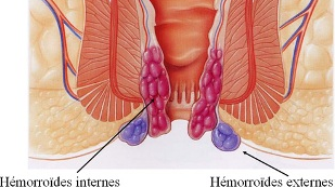 Les h&eacute;morro&iuml;des 