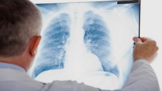 La tuberculose extra pulmonaire : pr&eacute;vention et traitement