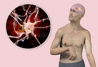 La maladie ( Chor&eacute;&eacute;) de Huntington