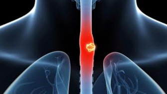 D&eacute;tection des ad&eacute;nopathies du cancer de loesophage : un cri dalarme rest&eacute; lettre morte !