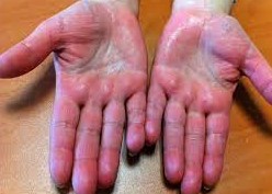 Pr&eacute;venir lAcrocyanose