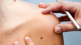 La k&eacute;ratose actinique