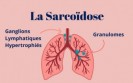 La sarco&iuml;dose