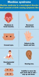 Le syndrome de M&oelig;bius